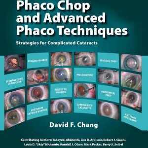 Phaco Chop and Advanced Phaco Techniques: Strategies for Complicated Cataracts
